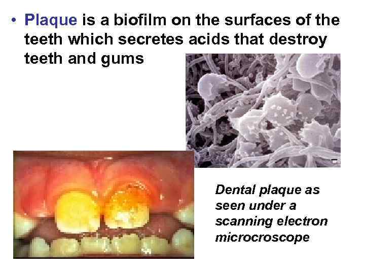  • Plaque is a biofilm on the surfaces of the teeth which secretes