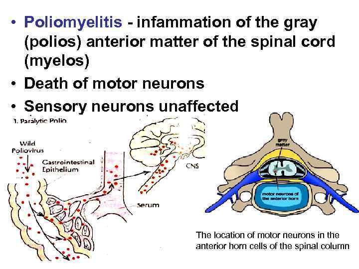  • Poliomyelitis - infammation of the gray (polios) anterior matter of the spinal