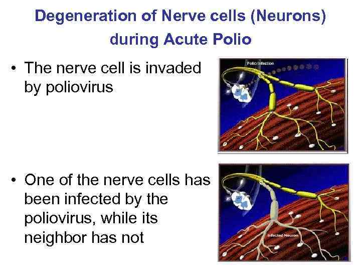 Degeneration of Nerve cells (Neurons) during Acute Polio • The nerve cell is invaded