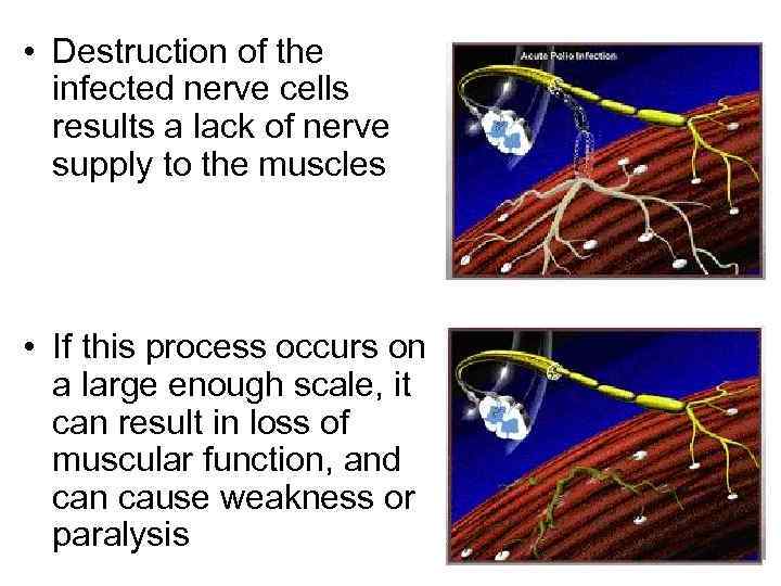  • Destruction of the infected nerve cells results a lack of nerve supply