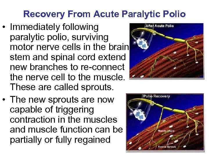 Recovery From Acute Paralytic Polio • Immediately following paralytic polio, surviving motor nerve cells