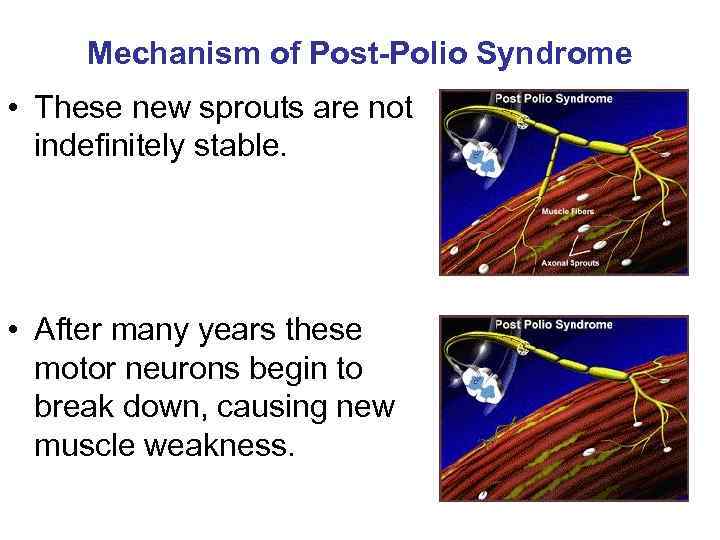 Mechanism of Post-Polio Syndrome • These new sprouts are not indefinitely stable. • After