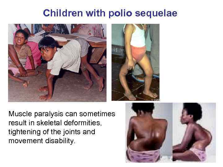 Children with polio sequelae Muscle paralysis can sometimes result in skeletal deformities, tightening of