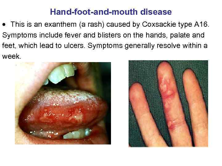 Hand-foot-and-mouth disease This is an exanthem (a rash) caused by Coxsackie type A 16.