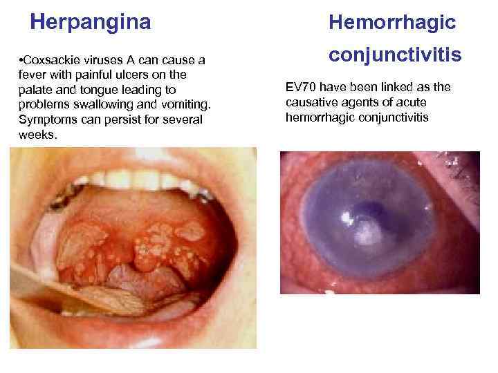 Herpangina • Coxsackie viruses A can cause a fever with painful ulcers on the