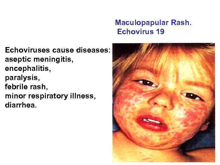  Echoviruses cause diseases: aseptic meningitis, encephalitis, paralysis, febrile rash, minor respiratory illness, diarrhea.