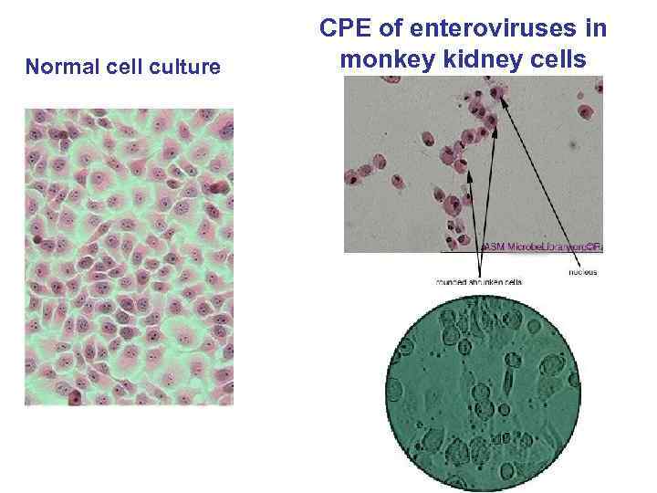 Normal cell culture CPE of enteroviruses in monkey kidney cells 