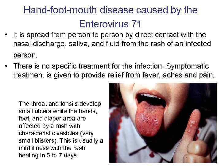 Hand-foot-mouth disease caused by the Enterovirus 71 • It is spread from person to