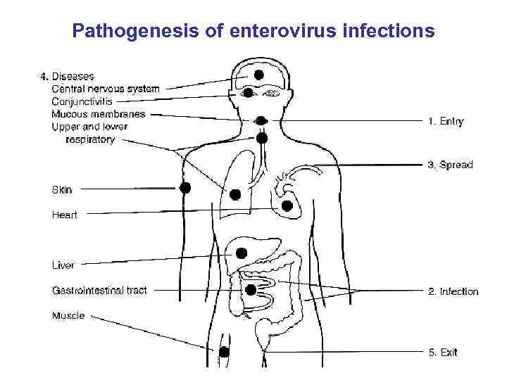 Pathogenesis of enterovirus infections 