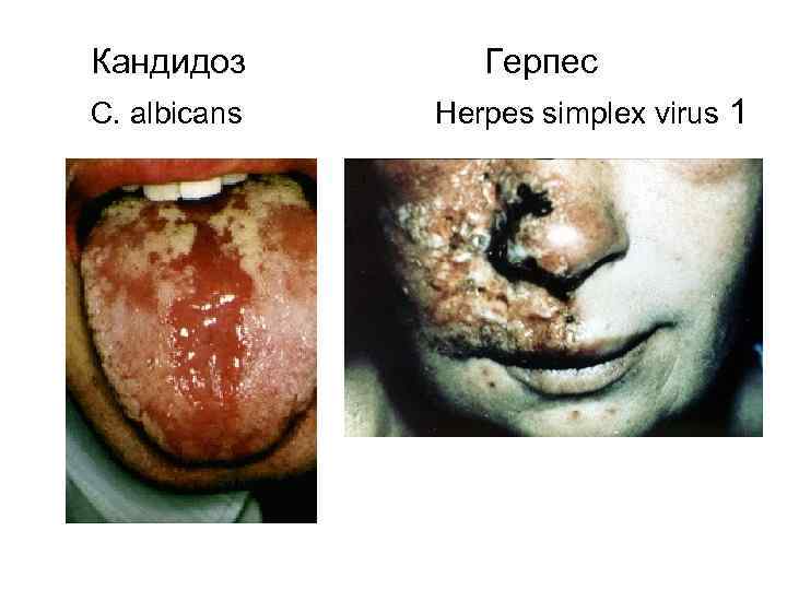  Кандидоз C. albicans Герпес Herpes simplex virus 1 