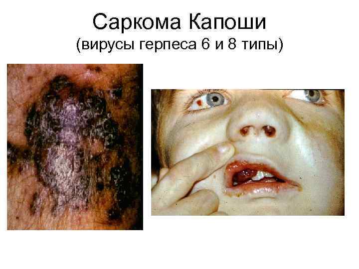 Саркома Капоши (вирусы герпеса 6 и 8 типы) 