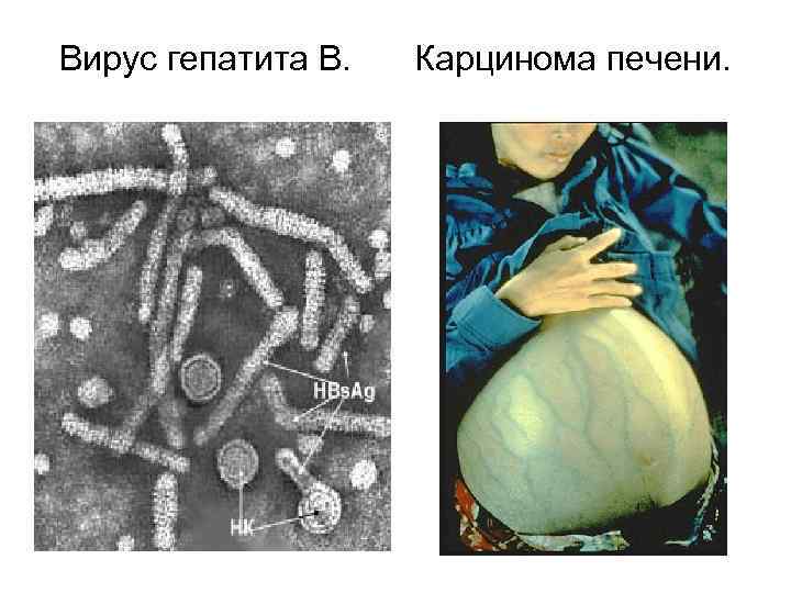 Вирус гепатита В. Карцинома печени. 