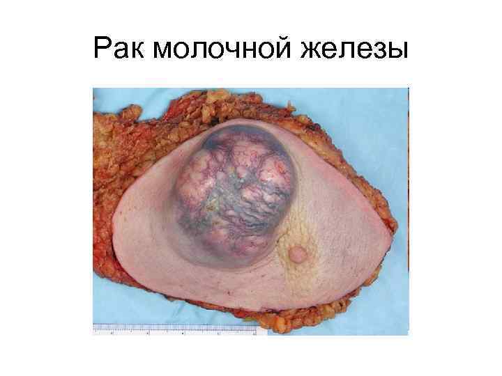 Рак молочной железы 