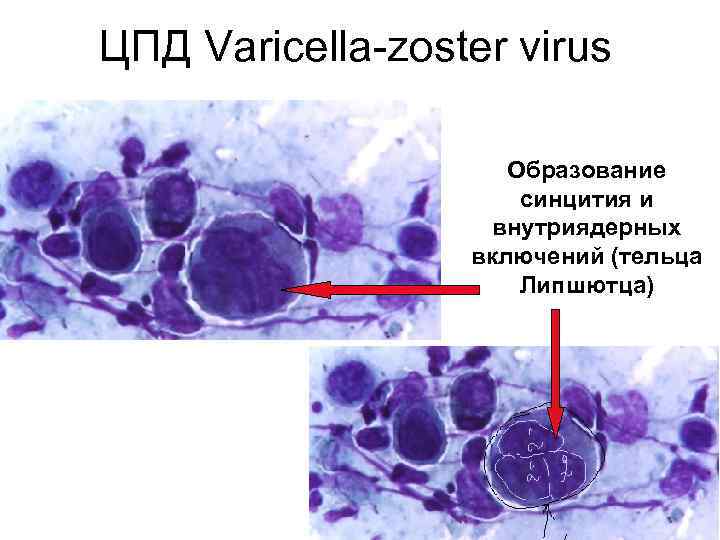 ЦПД Varicella-zoster virus Образование синцития и внутриядерных включений (тельца Липшютца) 