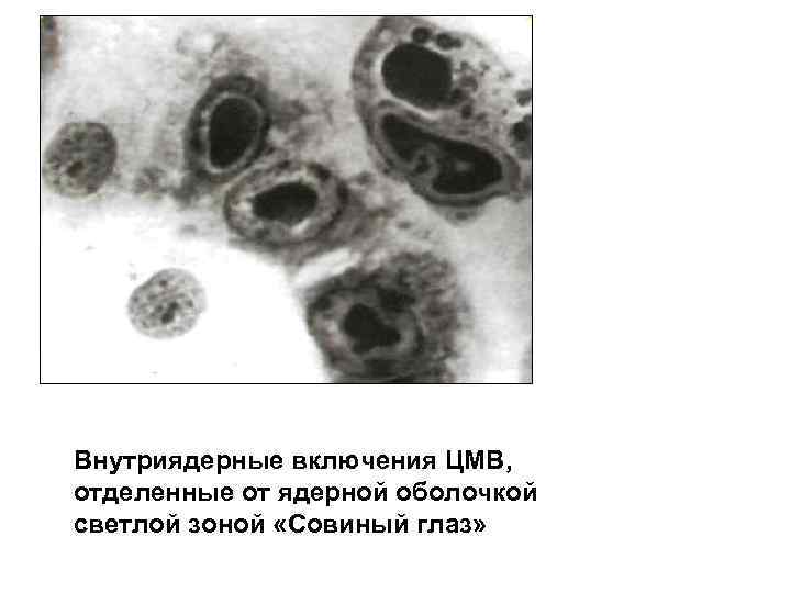Внутриядерные включения ЦМВ, отделенные от ядерной оболочкой светлой зоной «Совиный глаз» 