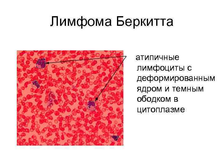 Лимфома Беркитта атипичные лимфоциты с деформированным ядром и темным ободком в цитоплазме 