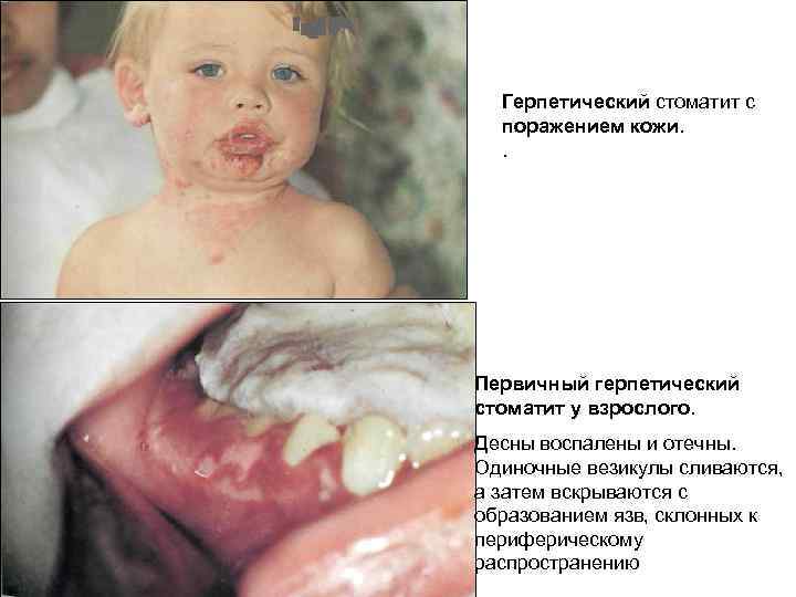 Герпетический стоматит с поражением кожи. . Первичный герпетический стоматит у взрослого. Десны воспалены и