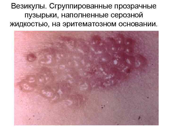 Везикулы. Сгруппированные прозрачные пузырьки, наполненные серозной жидкостью, на эритематозном основании. 