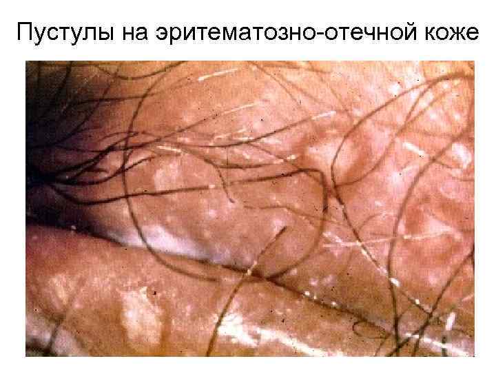 Пустулы на эритематозно-отечной коже 