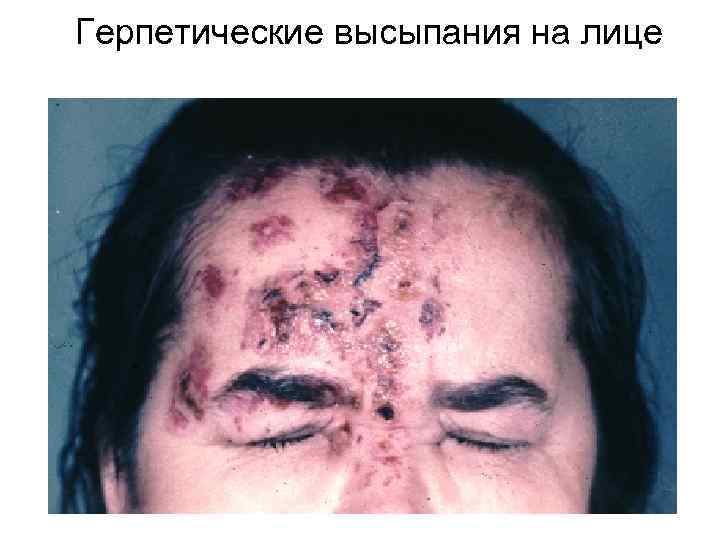 Герпетические высыпания на лице 