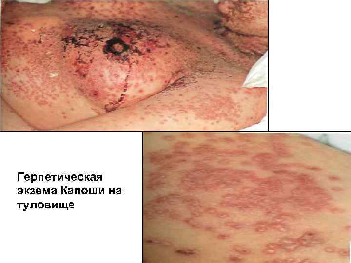 Герпетическая экзема Капоши на туловище 