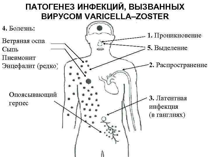 ПАТОГЕНЕЗ ИНФЕКЦИЙ, ВЫЗВАННЫХ ВИРУСОМ VARICELLA–ZOSTER 4. Болезнь: Ветряная оспа Сыпь Пневмонит Энцефалит (редко) Опоясывающий