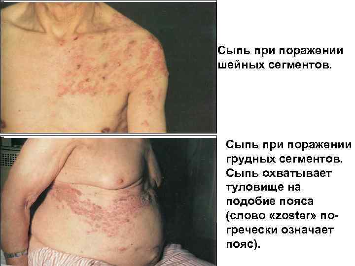 Сыпь при поражении шейных сегментов. Сыпь при поражении грудных сегментов. Сыпь охватывает туловище на