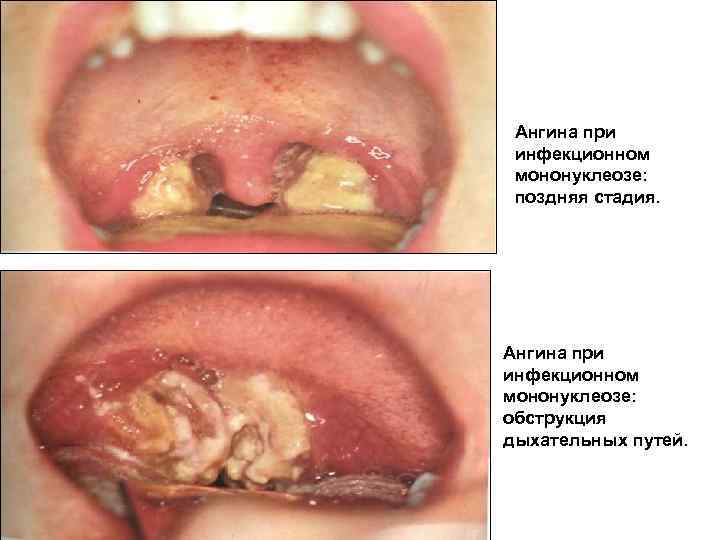 Ангина при инфекционном мононуклеозе: поздняя стадия. Ангина при инфекционном мононуклеозе: обструкция дыхательных путей. 