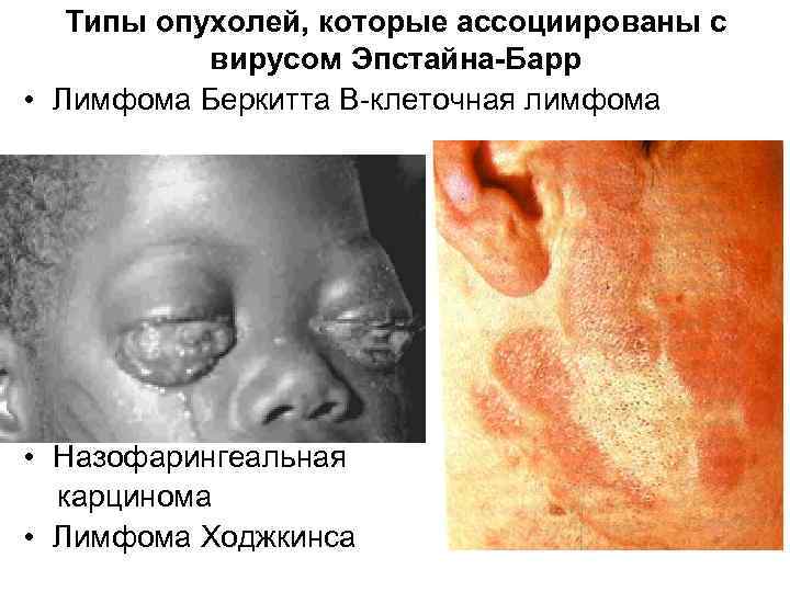 Типы опухолей, которые ассоциированы с вирусом Эпстайна-Барр • Лимфома Беркитта B-клеточная лимфома • Назофарингеальная
