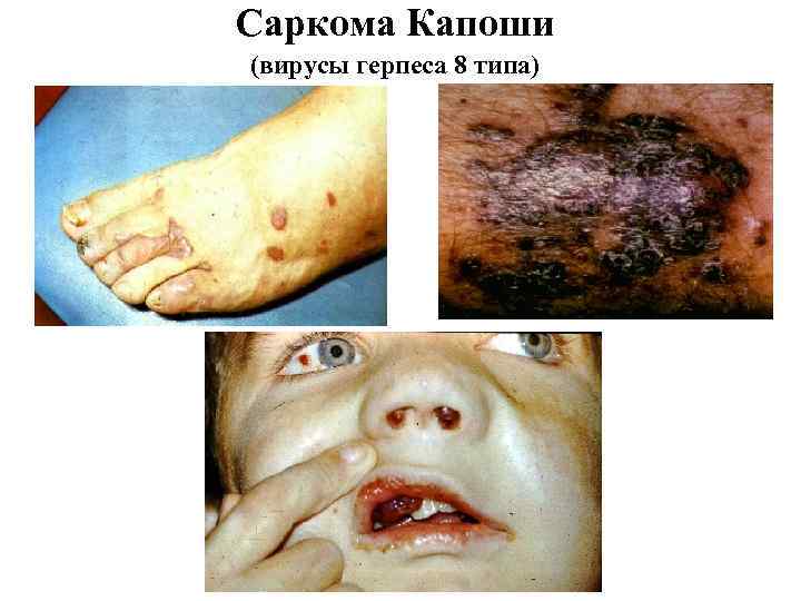 Саркома Капоши (вирусы герпеса 8 типа) 