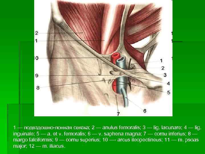 1 — подвздошно лонная связка; 2 — anulus femoralis; 3 — lig. lacunare; 4