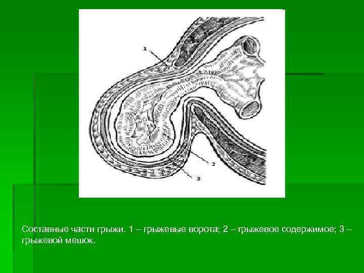 Составные части грыжи. 1 – грыжевые ворота; 2 – грыжевое содержимое; 3 – грыжевой