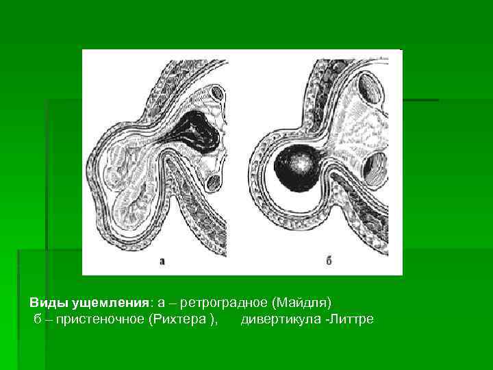 Виды ущемления: а – ретроградное (Майдля) б – пристеночное (Рихтера ), дивертикула Литтре 