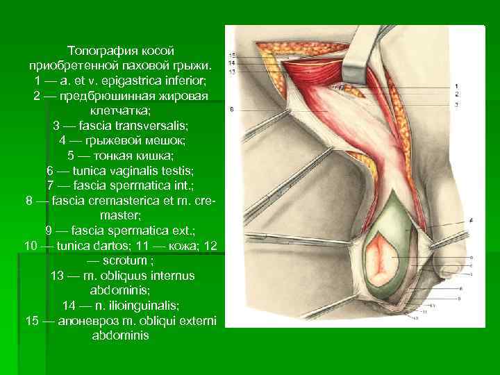 Топография косой приобретенной паховой грыжи. 1 — a. et v. epigastrica inferior; 2 —