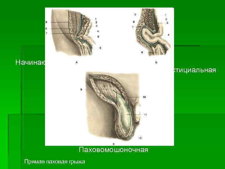 Прямую паховую грыжу характеризует слабость следующей стенки