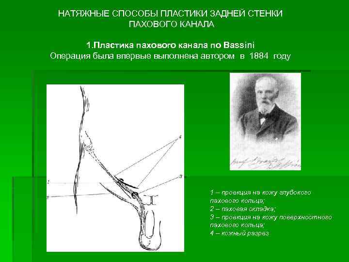 НАТЯЖНЫЕ СПОСОБЫ ПЛАСТИКИ ЗАДНЕЙ СТЕНКИ ПАХОВОГО КАНАЛА 1. Пластика пахового канала по Bassini Операция