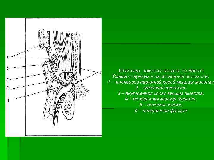 Пластику пахового канала. Схемы пластики пахового канала. Схема пластинки пахового канала. Паховый канал топографическая анатомия и Оперативная хирургия. Пластика пахового канала по ру.