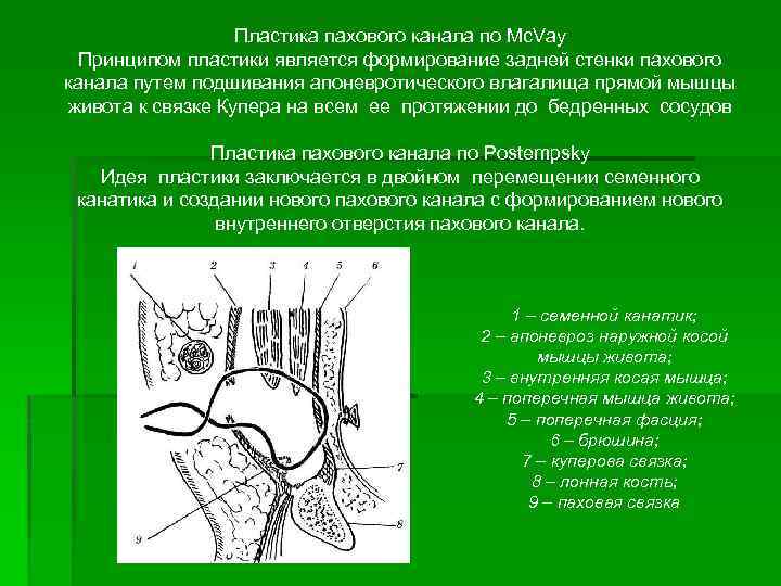 Пластика пахового канала по Mc. Vay Принципом пластики является формирование задней стенки пахового канала