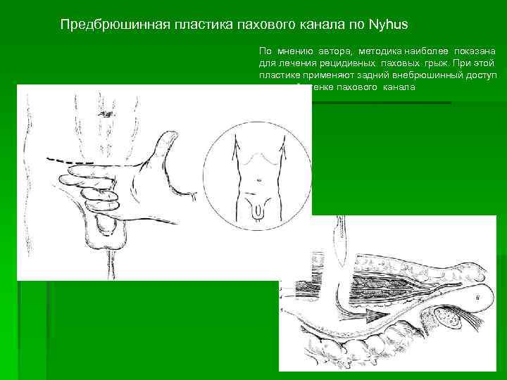 Предбрюшинная пластика пахового канала по Nyhus По мнению автора, методика наиболее показана для лечения