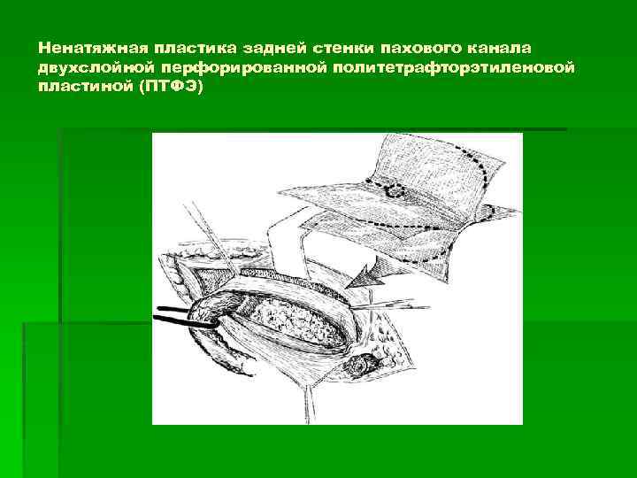 Ненатяжная пластика задней стенки пахового канала двухслойной перфорированной политетрафторэтиленовой пластиной (ПТФЭ) 