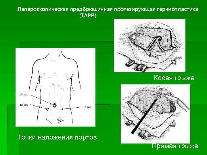 Лапароскопическая предбрюшинная протезирующая герниопластика (ТАРР) Косая грыжа Точки наложения портов Прямая грыжа 