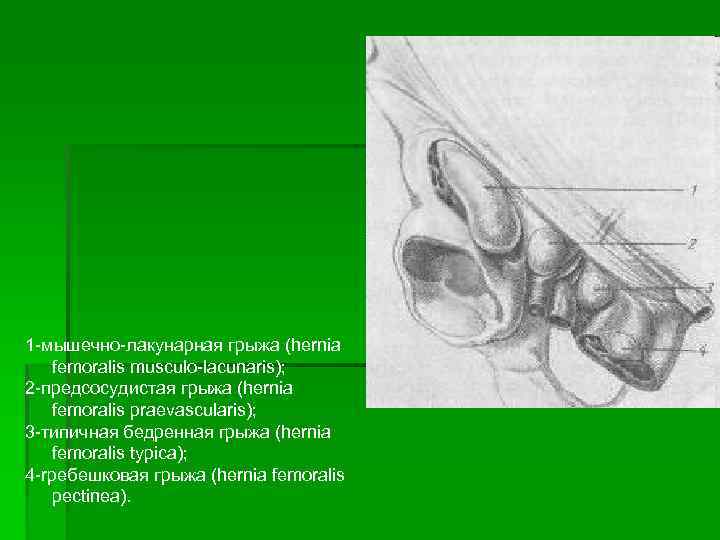 1 мышечно лакунарная грыжа (hernia femoralis musculo lacunaris); 2 предсосудистая грыжа (hernia femoralis praevascularis);