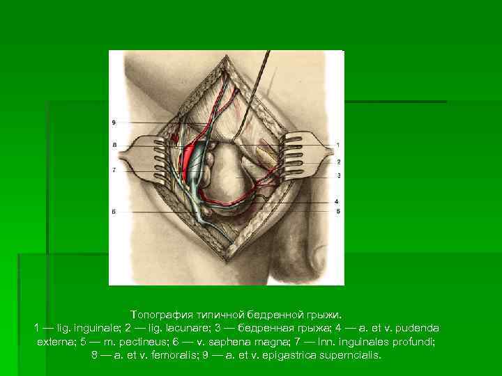 Топография типичной бедренной грыжи. 1 — lig. inguinale; 2 — lig. lacunare; 3 —