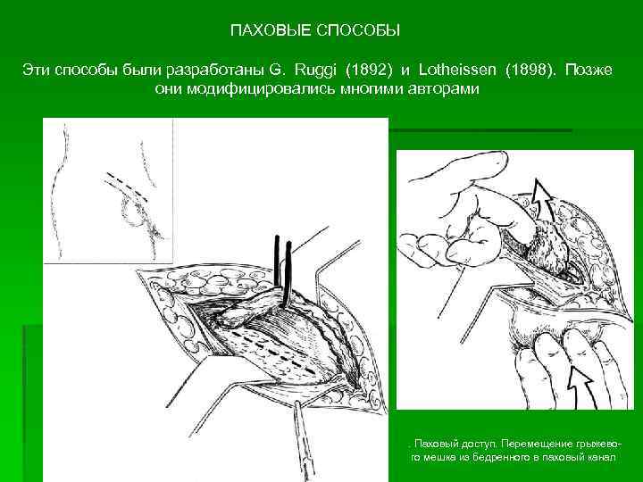 Бедренный способ при бедренной грыже. Руджи Парлавеччио пластика. Операция Руджи Парлавеччио. Способ Руджи Парлавеччио. Пластика бедренной грыжи по Руджи-Парлавеччо схема.