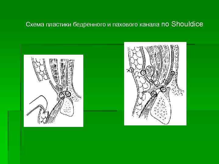 Схема пластики бедренного и пахового канала по Shouldice 