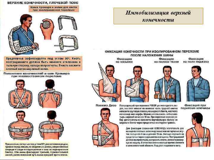 Иммобилизация верхней конечности 