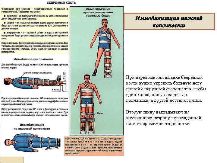 Иммобилизация нижней конечности При переломе или вывихе бедренной кости нужно укрепить больную ногу шиной