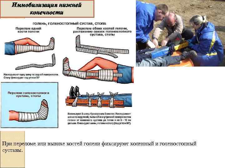 Иммобилизация нижней конечности При переломе или вывихе костей голени фиксируют коленный и голеностопный суставы.