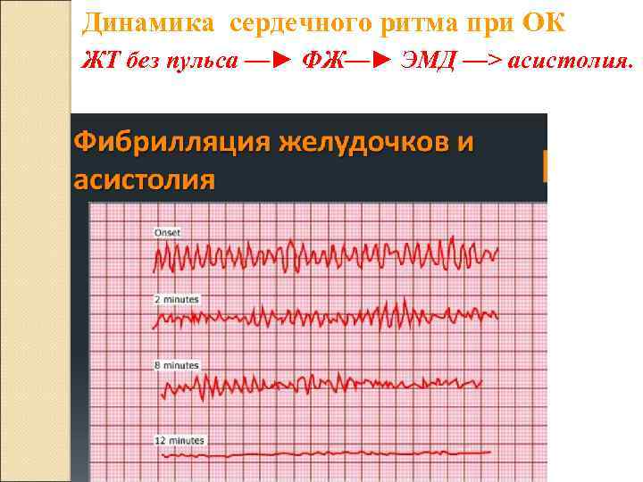 Динамика сердечного ритма при ОК ЖТ без пульса —► ФЖ—► ЭМД —> асистолия. 