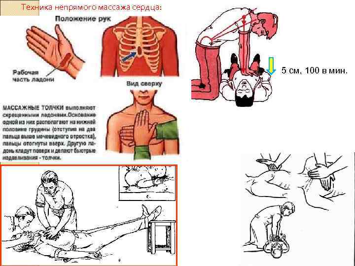 Техника непрямого массажа сердца: 5 см, 100 в мин. 